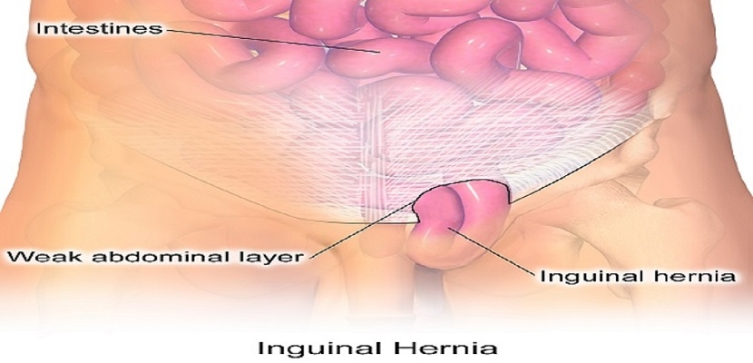 &quot;الفتق الإربي&quot; Inguinal hernia ، وأسبابه، وأعراضه